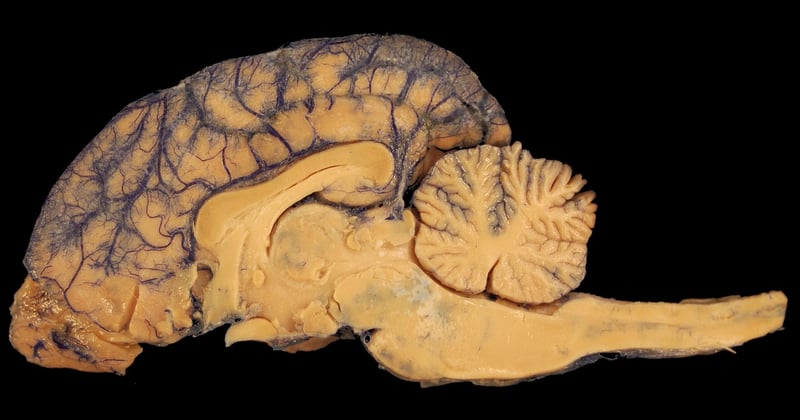Corps calleux : pourquoi cette structure du cerveau est essentielle